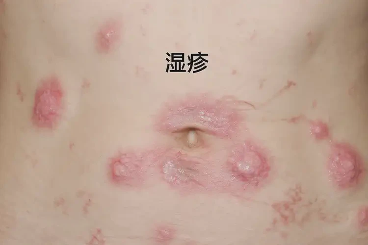 男人肚子上長濕疹可不可以根治(圖4)