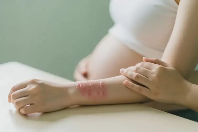 孕婦手臂偶爾起濕疹可以治好嗎(圖2)
