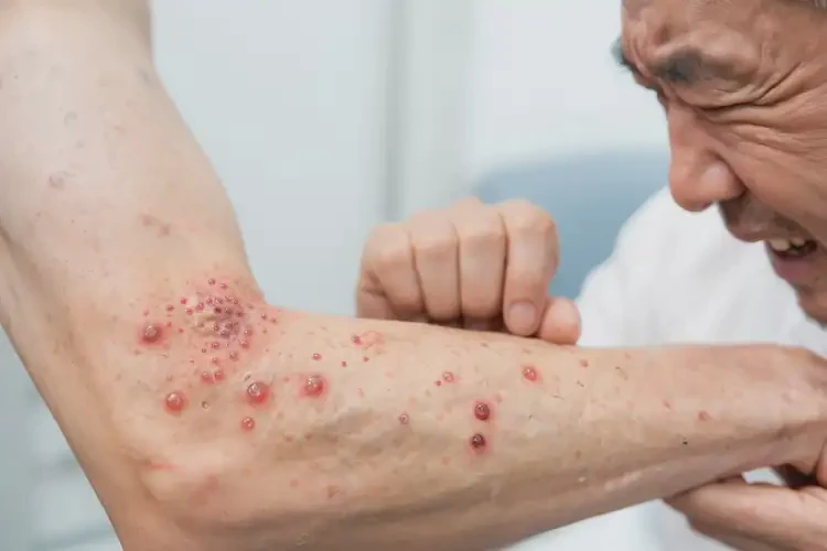 大學(xué)生脖子上出現(xiàn)濕疹不管它會(huì)自己自愈嗎(圖4)