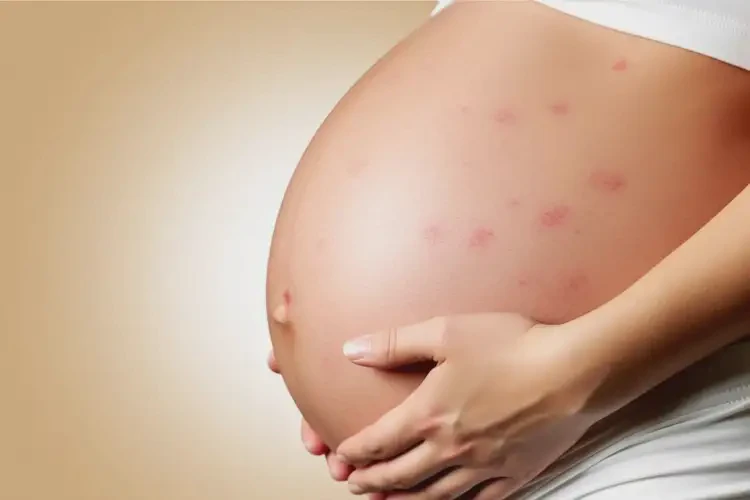 孕婦肚子上偶爾起濕疹可以治好嗎(圖4)