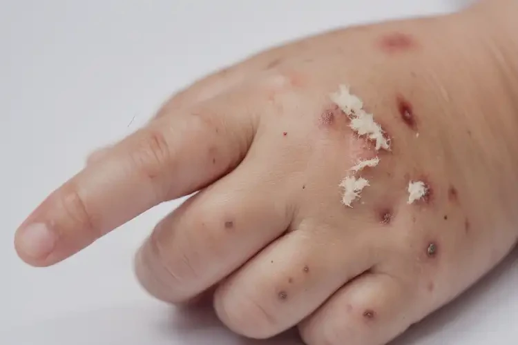 小孩手上經(jīng)常起濕疹能徹底自愈嗎(圖4)