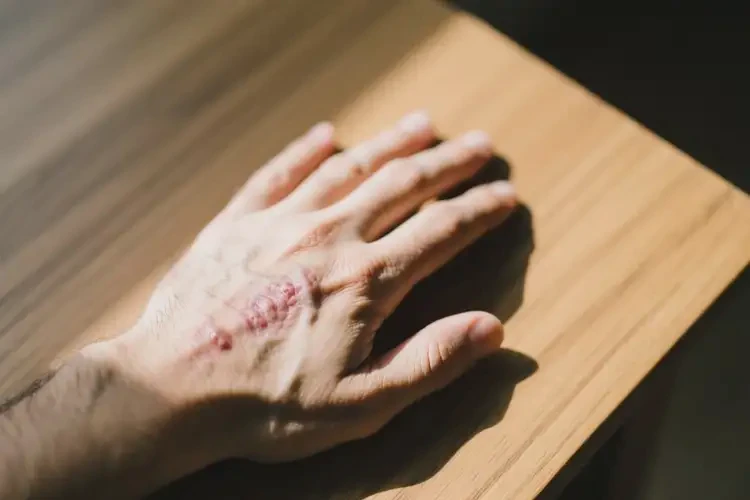 男性手上出濕疹可不可以根治(圖2)