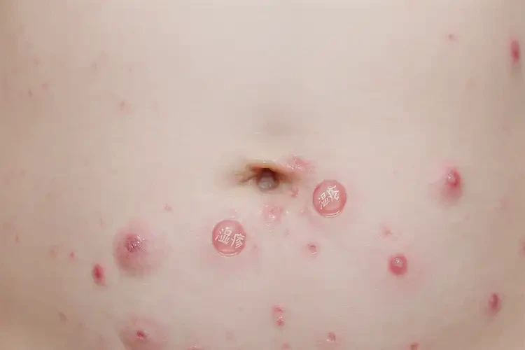 小孩肚子有濕疹可不可以根治(圖4)