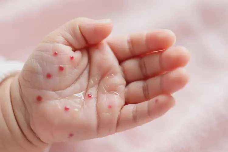 新生兒手上起濕疹可不可以根治(圖3)