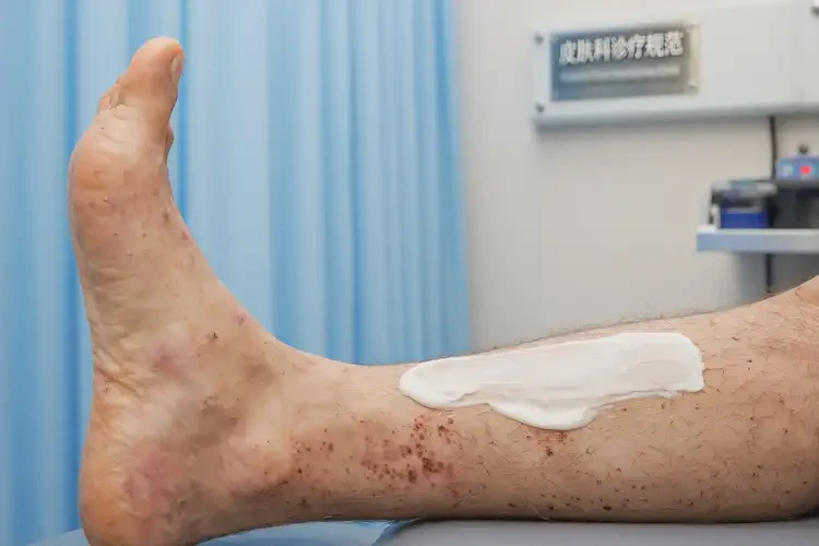 男人小腿出現(xiàn)濕疹可不可以根治(圖3)