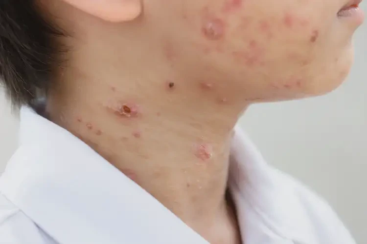 中學(xué)生脖子上長濕疹可不可以根治(圖4)