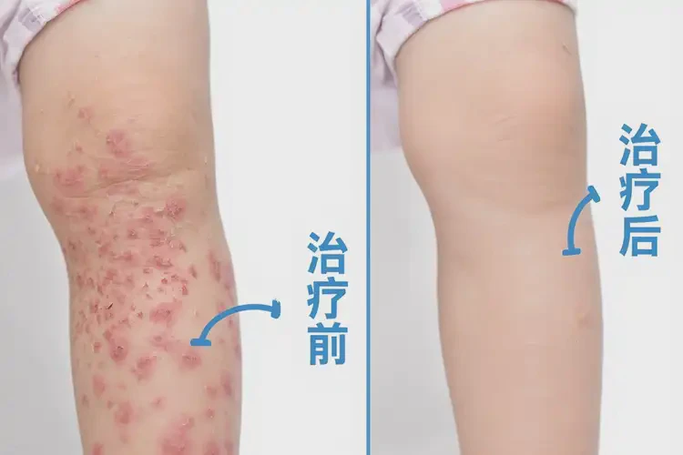 少儿四肢经常长湿疹可以治好吗(图4)