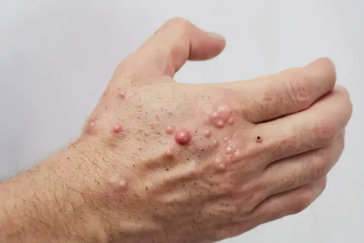 男性手上偶爾長濕疹可不可以根治(圖3)