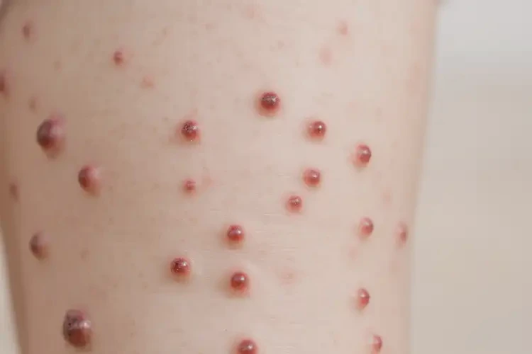 小兒大腿上有濕疹可不可以根治(圖4)