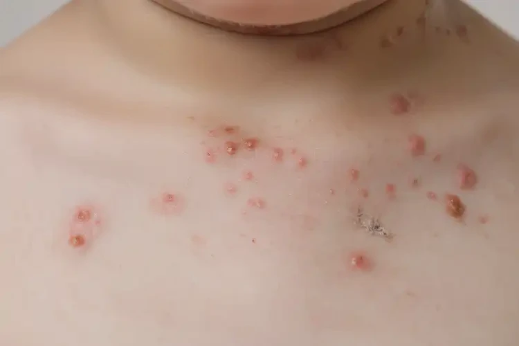 少兒脖子上出濕疹可不可以根治(圖4)