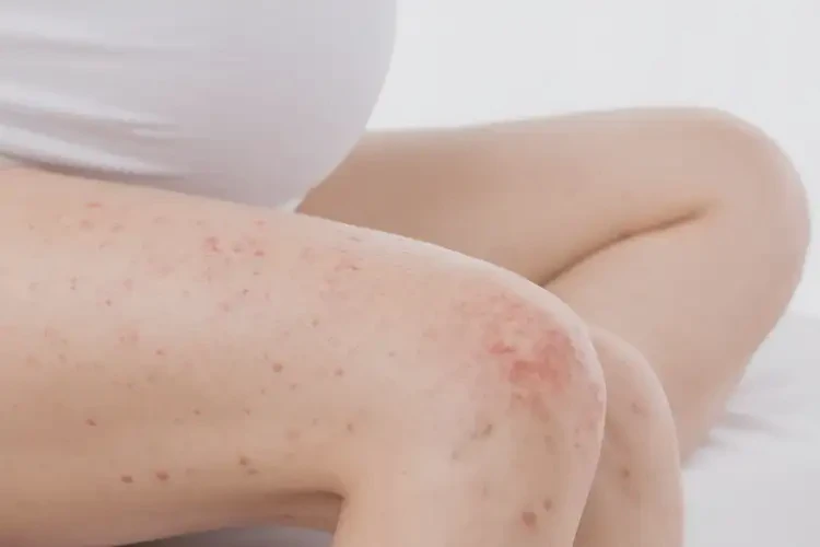 產(chǎn)婦大腿容易長(zhǎng)濕疹可不可以根治(圖4)