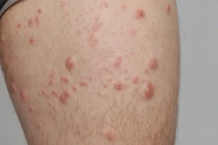 青年人大腿經(jīng)常起濕疹可不可以根治(圖4)