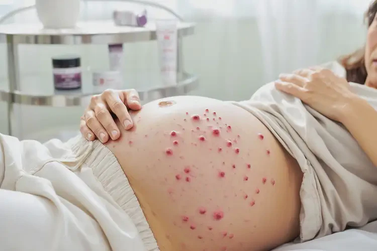 孕婦肚子上經(jīng)常起濕疹可不可以根治(圖4)