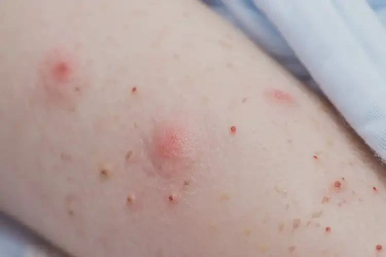 嬰幼兒手臂出現(xiàn)濕疹可不可以根治(圖4)