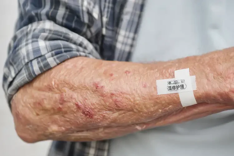 老人手臂經(jīng)常長濕疹可不可以根治(圖4)