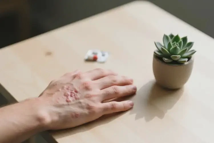 青年人手上起濕疹可不可以根治(圖2)