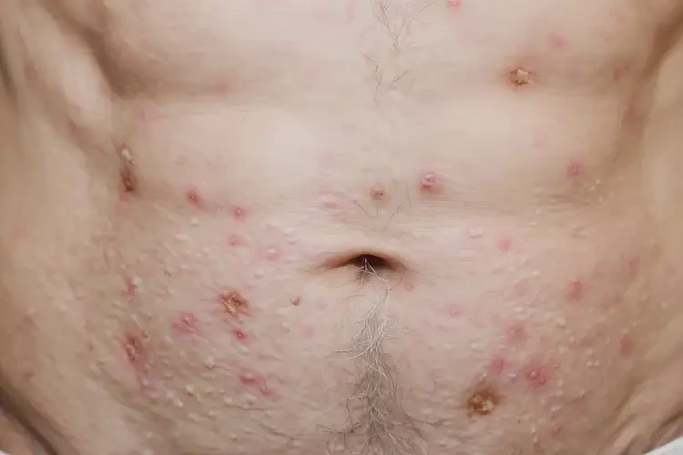 高齡老人肚子容易長(zhǎng)濕疹可不可以根治(圖4)