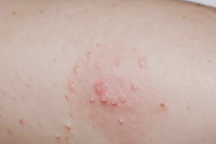 产妇小腿偶尔起湿疹可以治好吗(图4)