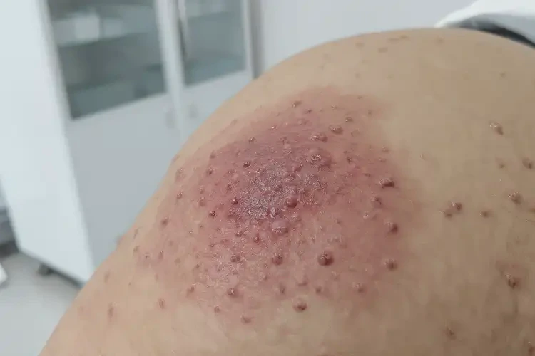 小孩屁股上容易長濕疹可不可以根治(圖4)