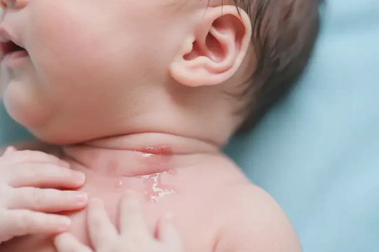 新生兒脖子上出濕疹可不可以根治(圖3)