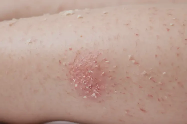 孩子小腿上起濕疹可以治好嗎(圖4)