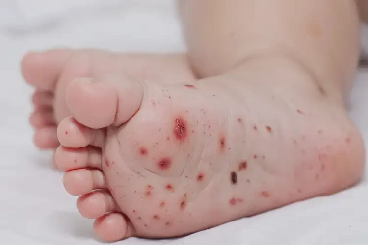 嬰幼兒腳上有濕疹可以治好嗎(圖4)