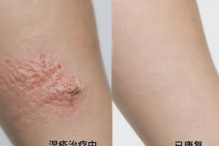 孩子手上起濕疹可以治好嗎(圖4)