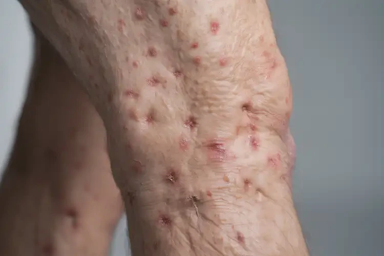 老年人大腿容易起湿疹可不可以根治(图4)