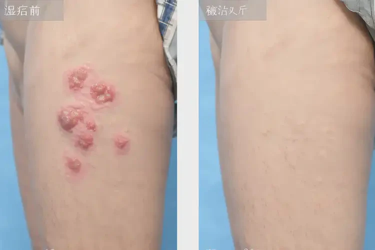 青年人肚子起湿疹可不可以根治(图3)