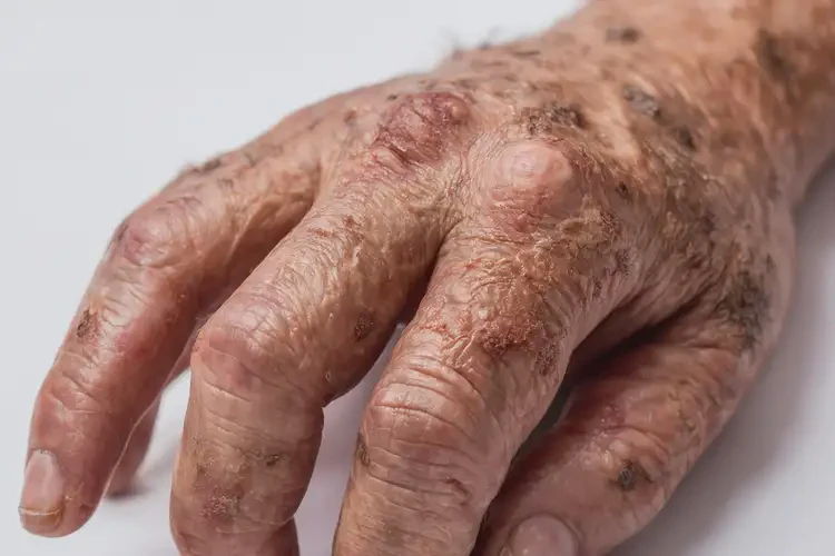 青年人手上容易長(zhǎng)濕疹不管它會(huì)自己好嗎(圖2)