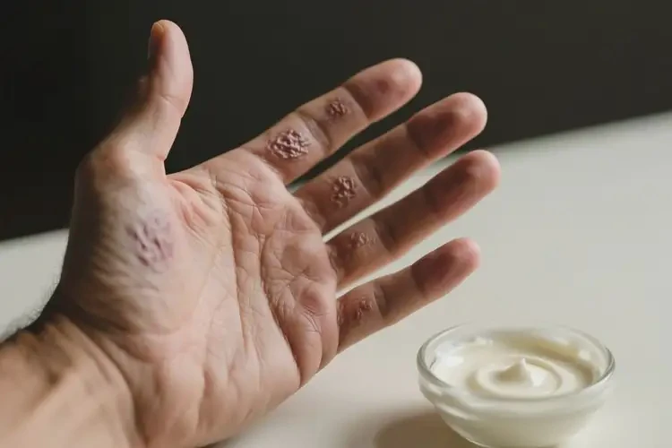 男性手上出濕疹可不可以根治(圖1)