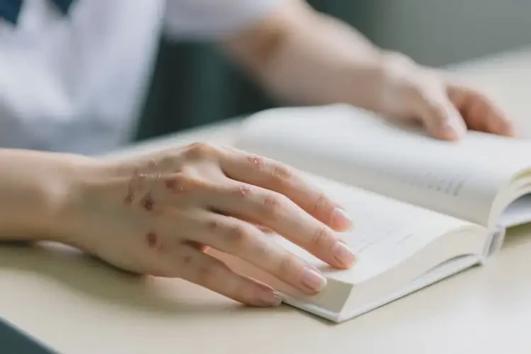 大學生手上長濕疹可不可以根治(圖3)