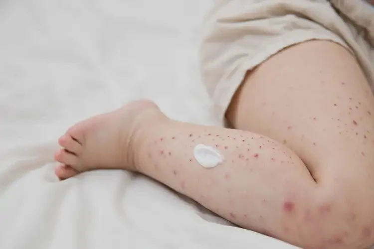 幼兒小腿上起濕疹可以徹底自愈嗎(圖2)