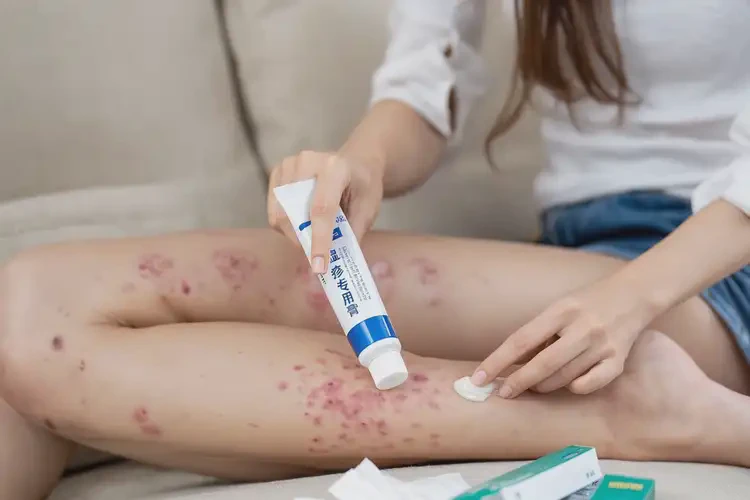 女性小腿上偶爾長(zhǎng)濕疹可以治好嗎(圖3)