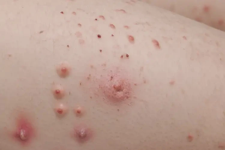 兒童大腿經(jīng)常長濕疹可以治好嗎(圖4)