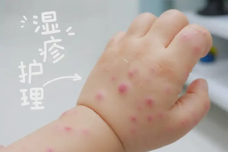 少兒身上偶爾起濕疹不管它會自己好嗎(圖4)