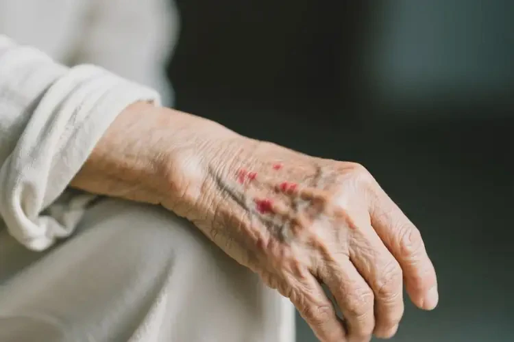 老人手臂出濕疹可以治好嗎(圖3)