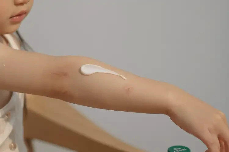 小学生手臂有湿疹可不可以彻底自愈(图2)