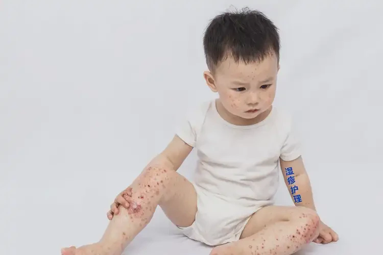 幼兒全身容易起濕疹不管它會自己好嗎(圖4)