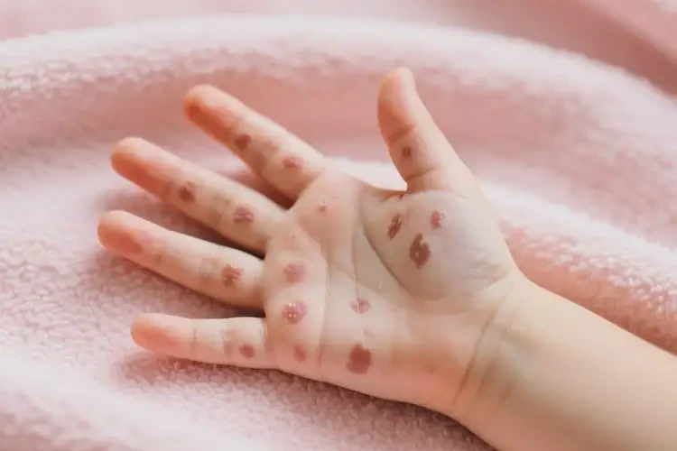 兒童手上出現(xiàn)濕疹可以治好嗎(圖1)