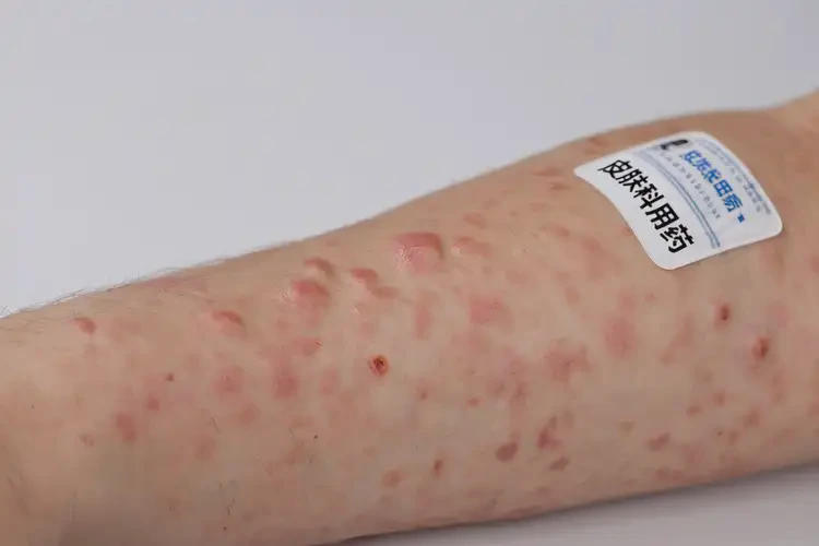 青少年手臂上起濕疹可不可以根治(圖4)