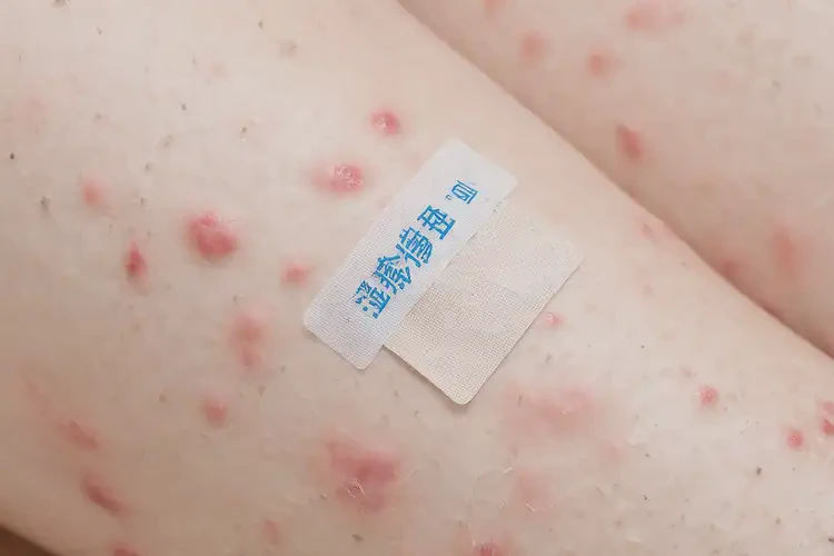 女生小腿上長濕疹可不可以根治(圖4)