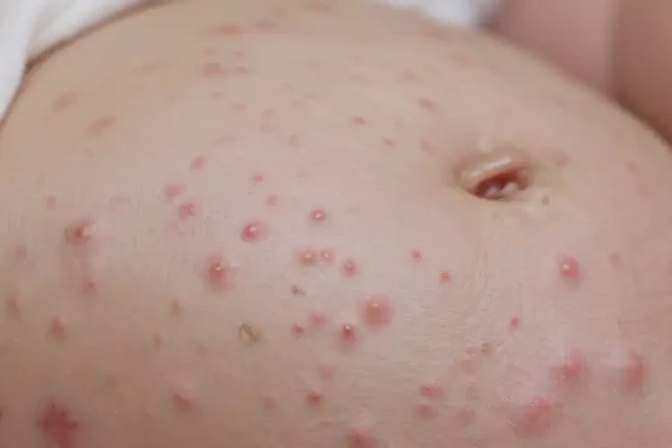 新生兒肚子出現(xiàn)濕疹可不可以根治(圖4)