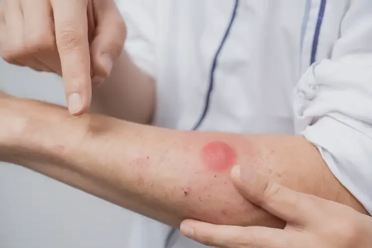 大學(xué)生手臂偶爾起濕疹可不可以根治(圖4)