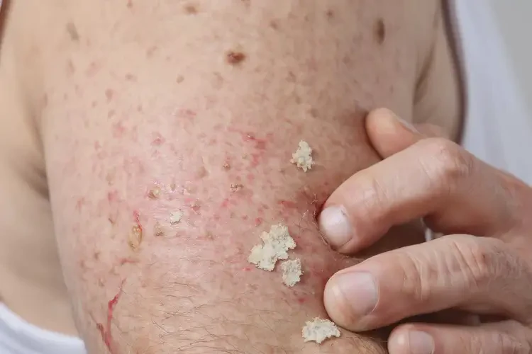 男人身上偶爾長濕疹可不可以根治(圖4)