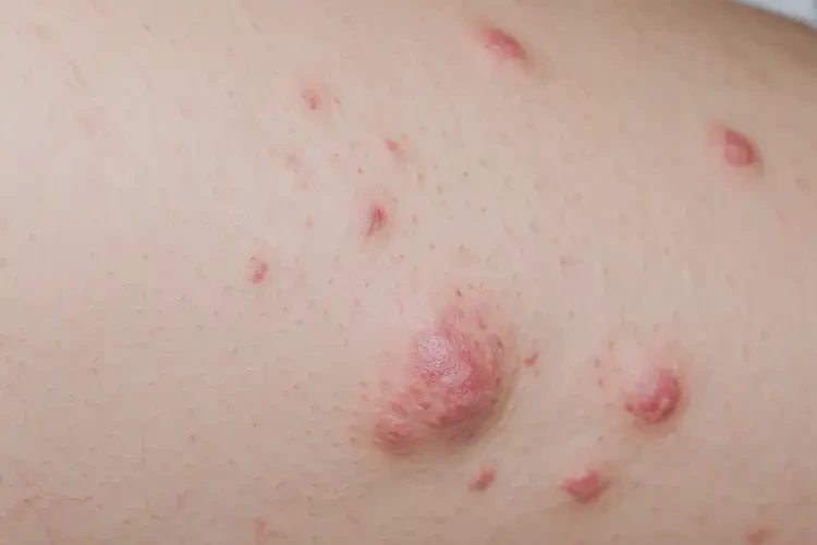 產(chǎn)婦大腿上容易長濕疹可以徹底自愈嗎(圖4)