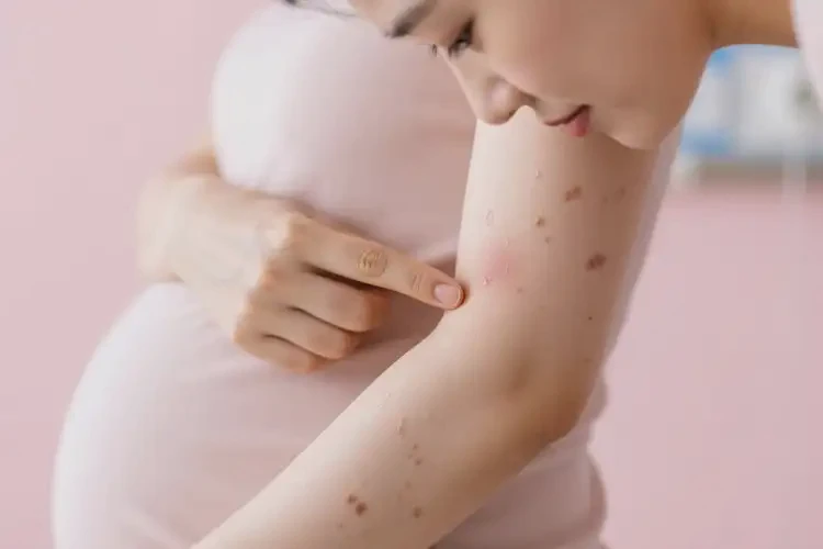 孕婦手臂偶爾起濕疹可以治好嗎(圖3)