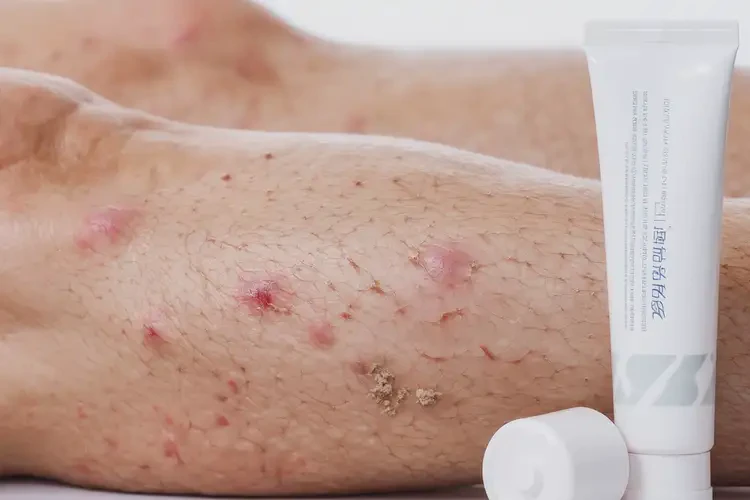 高齡老人小腿經(jīng)常起濕疹可不可以根治(圖4)