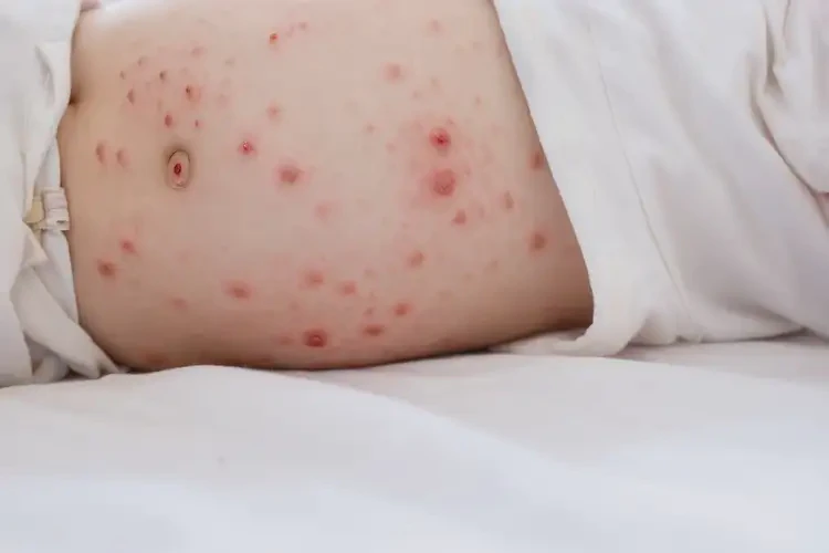 幼兒肚子上經(jīng)常長濕疹可不可以根治(圖4)