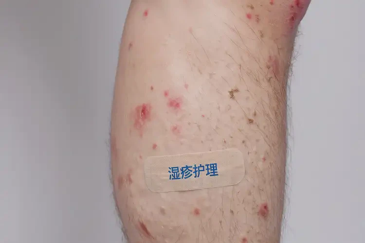 男生小腿长湿疹可不可以根治(图4)